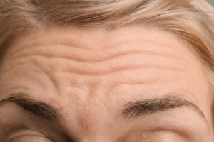 how-to-get-rid-of-forehead-wrink - Daily Health Tips: Simple Tricks for a Healthier Life Forehead Wrinkles